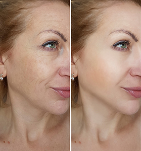PRP Facial before and after results showing reduced fine lines and improved skin tone