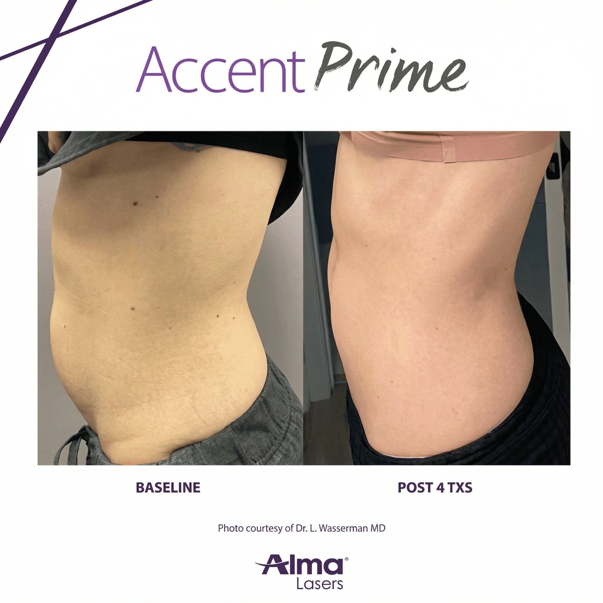 Accent Prime before and after comparison showing baseline versus post 4 treatments with visible body contouring and skin tightening on torso