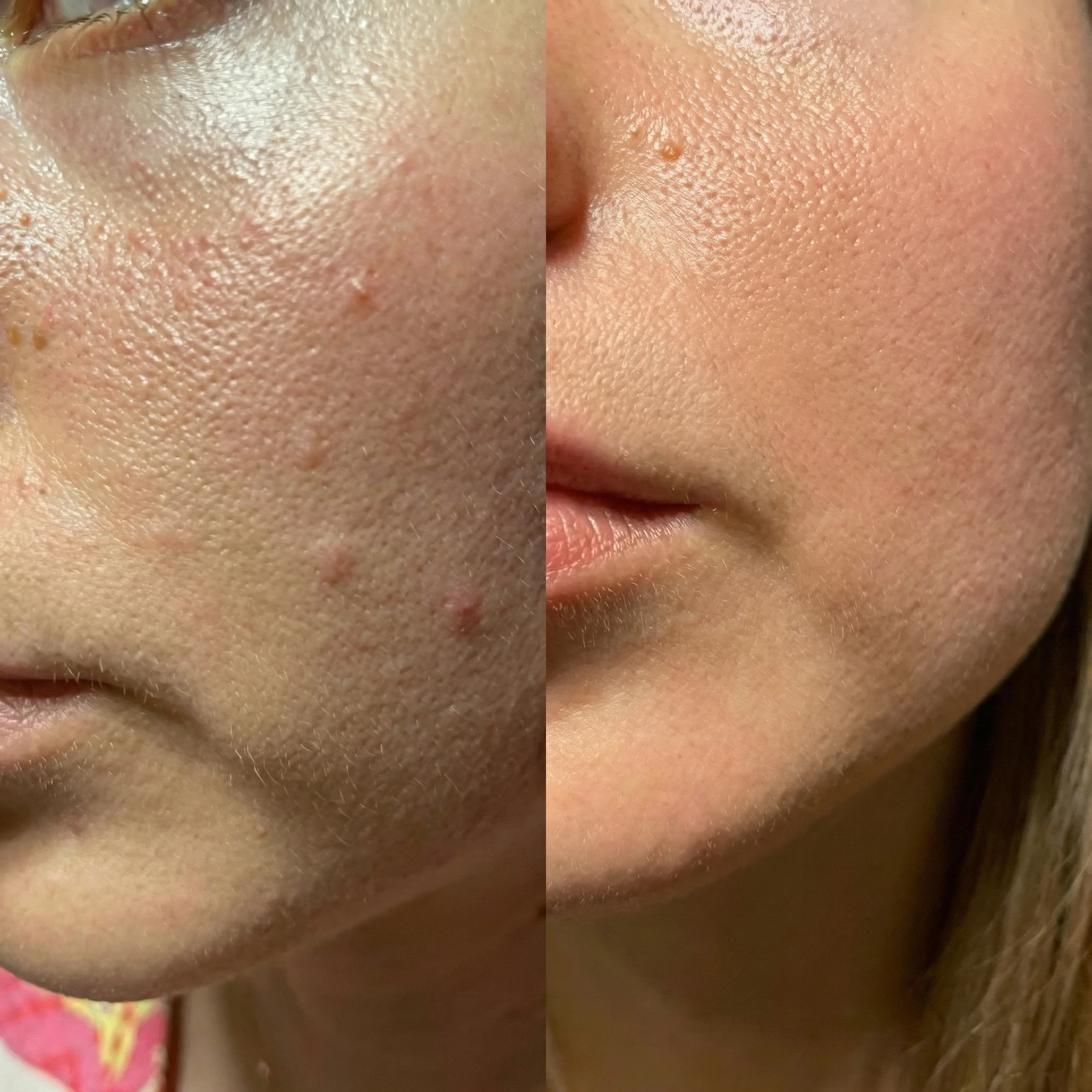 Exosome facial before and after comparison showing improved skin texture, reduced blemishes, and smoother complexion