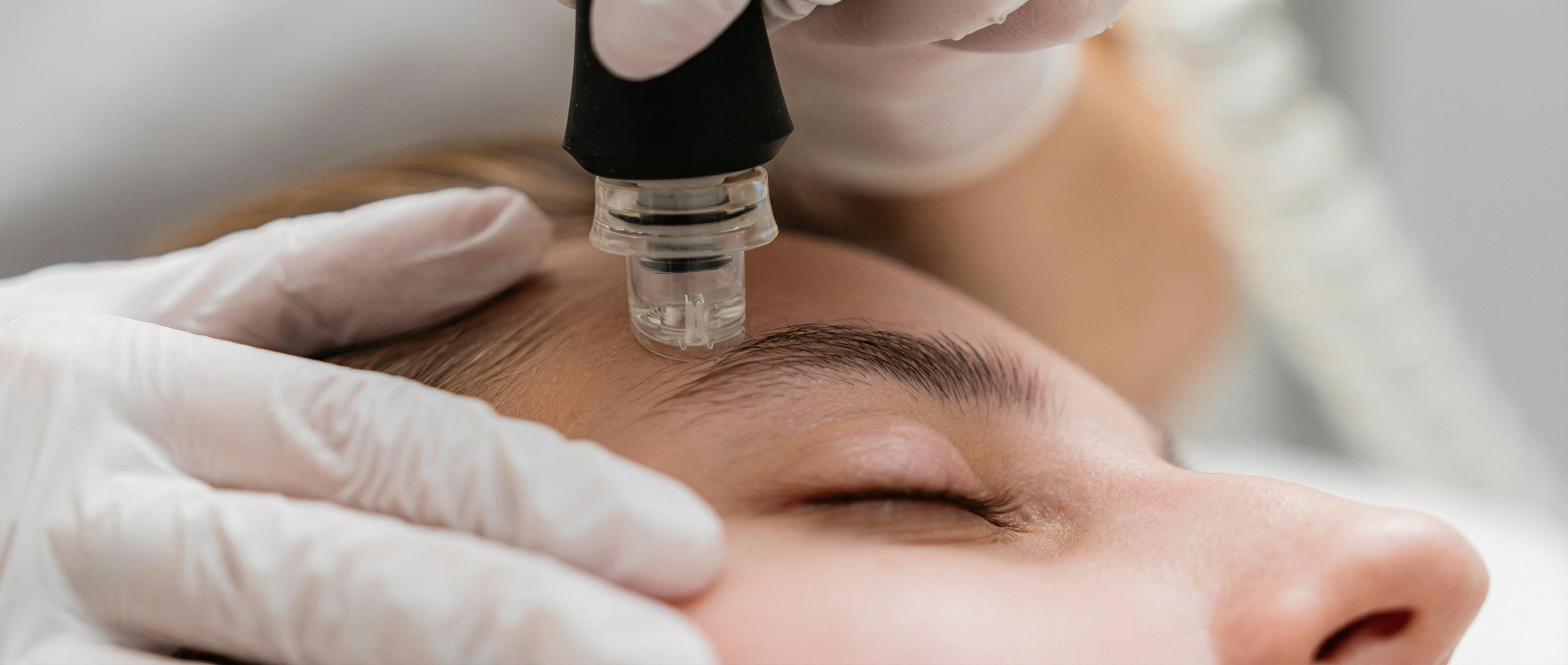 Close-up of microneedling device being applied to patient's forehead during exosome facial treatment