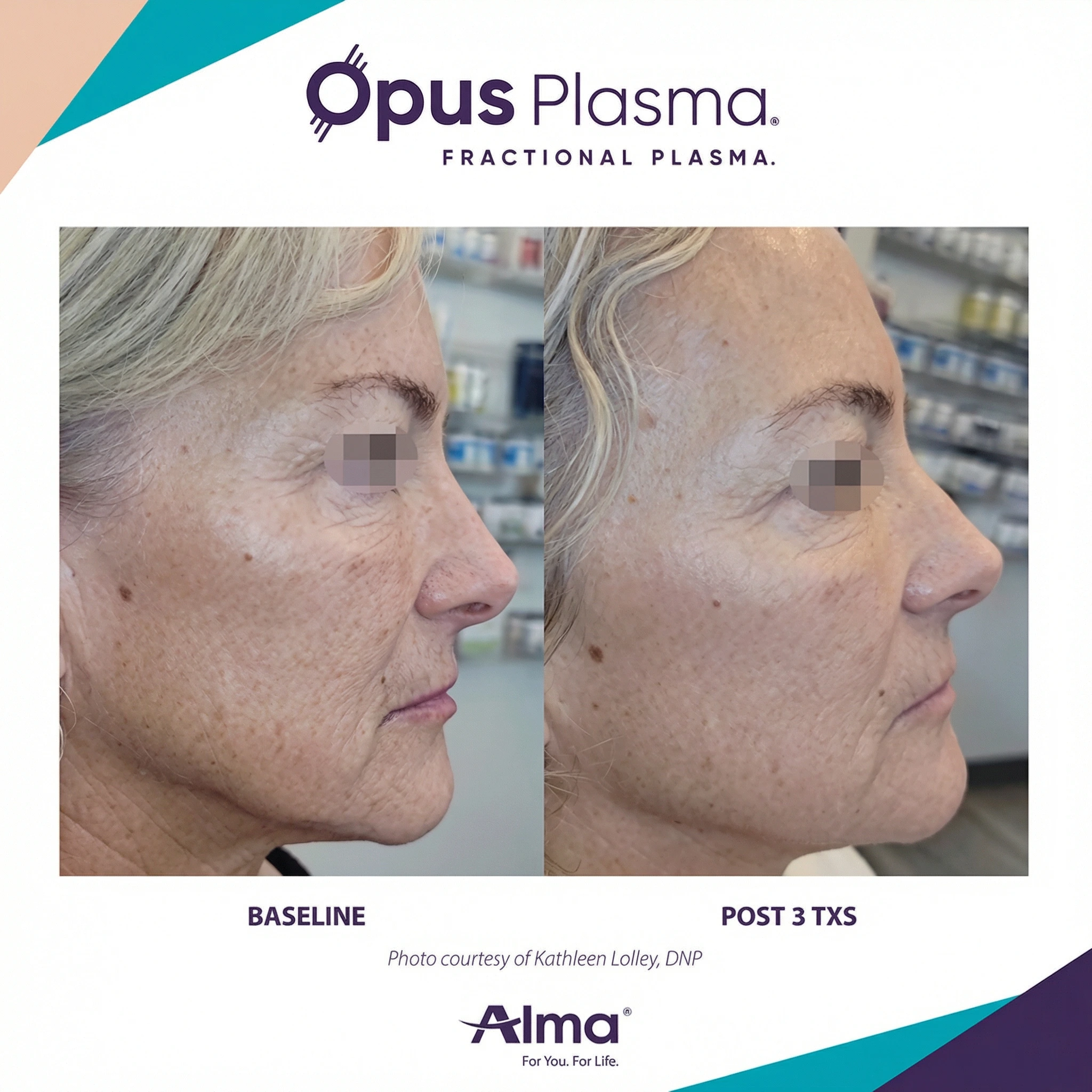 Opus Plasma before and after comparison showing baseline versus post 3 treatments with visible skin tightening and wrinkle reduction on face profile